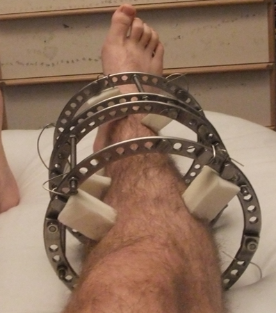 Illizarov Surgery